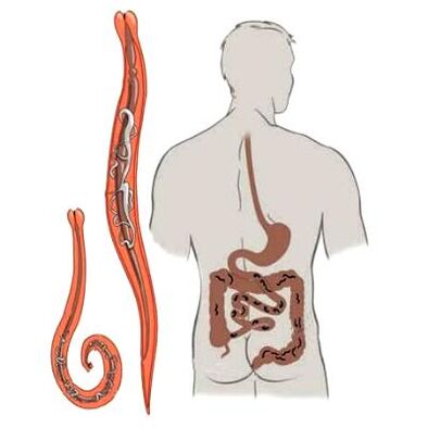 Parassiti nell'intestino umano
